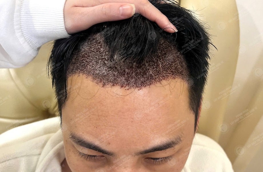 Lê Tuấn Tùng - Cấy tóc đường chữ M 6