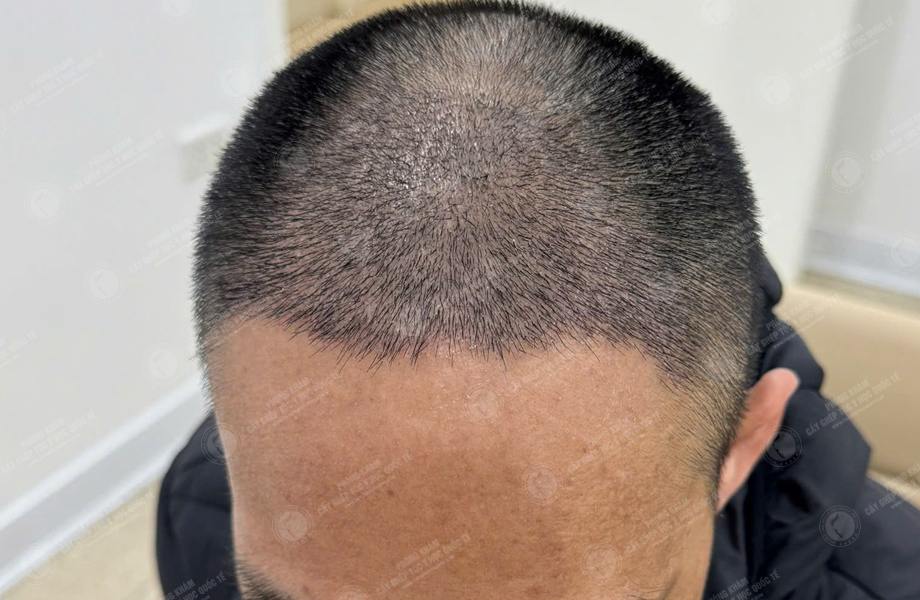 Nguyễn Đức Tâm - Cấy tóc đường chữ M 6