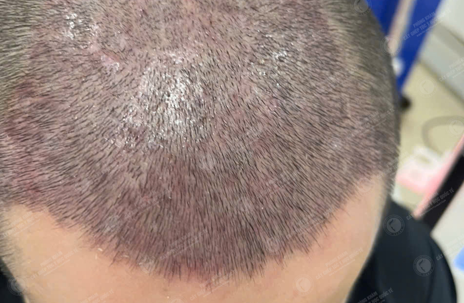 Hoàng Văn Chung - Cấy tóc đường chữ M 6