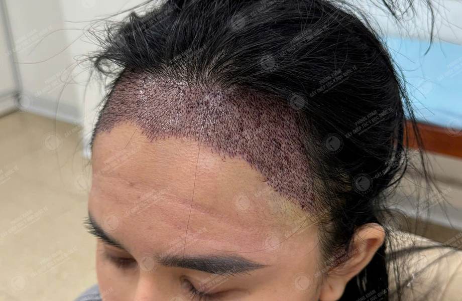 Nguyễn Tuyết Lan - Cấy tóc đường chữ M 6