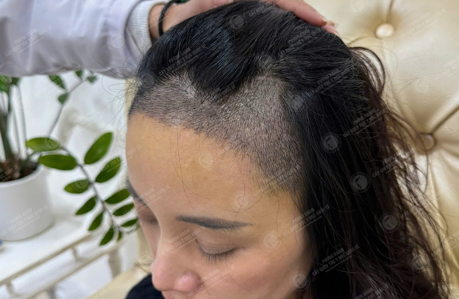 Lê Ánh Nguyệt - Cấy tóc đường chữ M 6