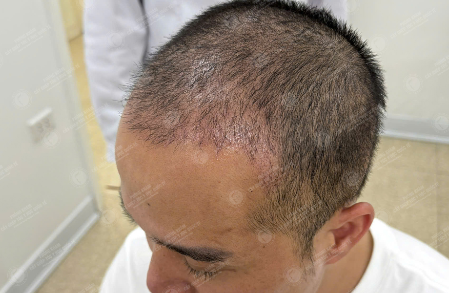 Trần Quốc Hoàn - Cấy tóc đường chữ M 6