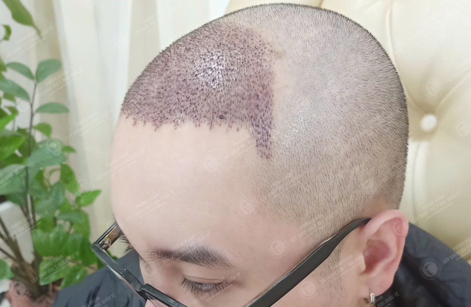 Bùi Văn Nguyên - Cấy tóc đường chữ M 6