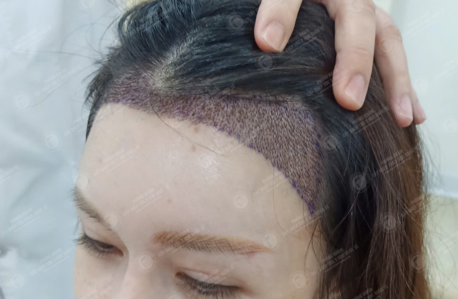 Nguyễn Mai Hoa - Cấy tóc đường chữ M 6