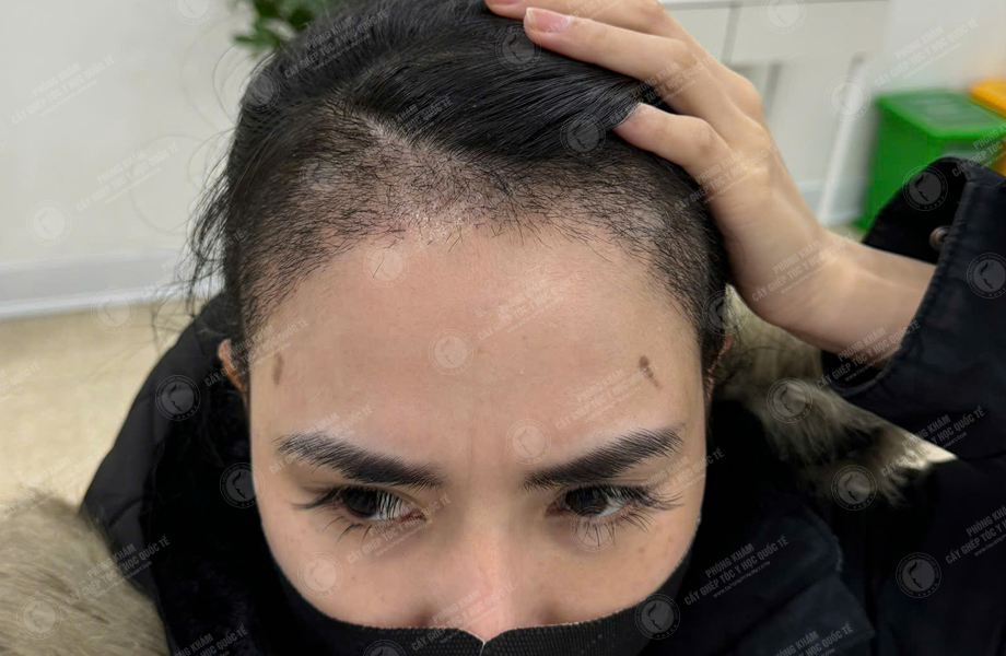 Nguyễn Tuyết Mai - Cấy tóc đường chữ M 7