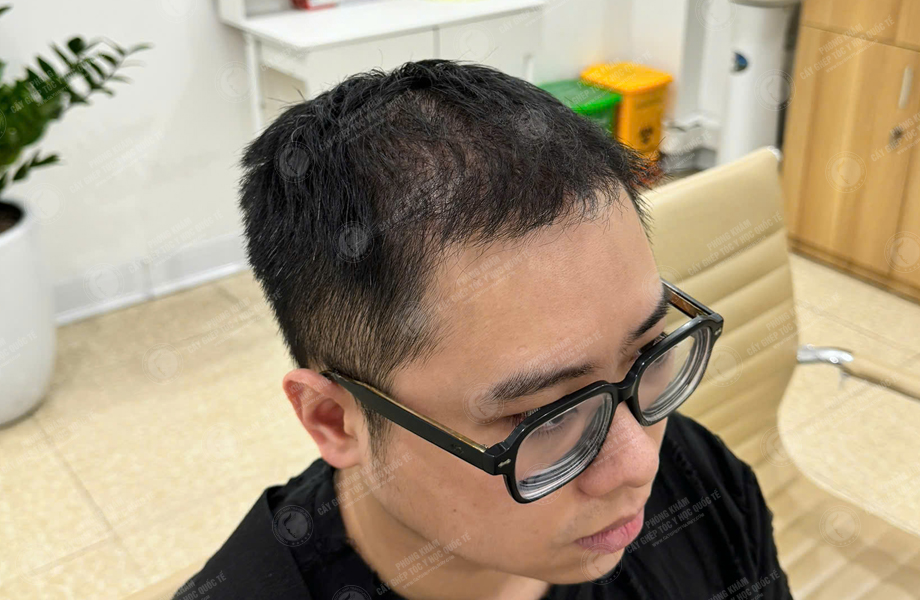 Bùi Văn Nguyên - Cấy tóc đường chữ M 7
