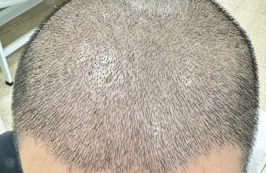 Nguyễn Hữu Cường - Cấy tóc đường chữ M 7