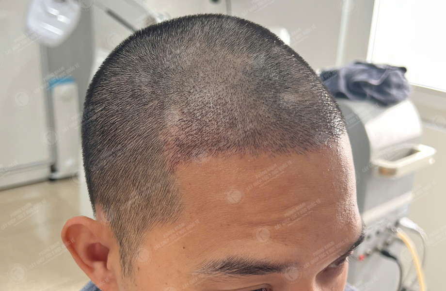 Lê Thanh Sơn - Cấy tóc đường chữ M 7