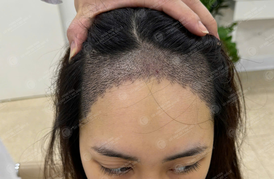 Trần Thị Hồng - Cấy tóc đường chữ M 7