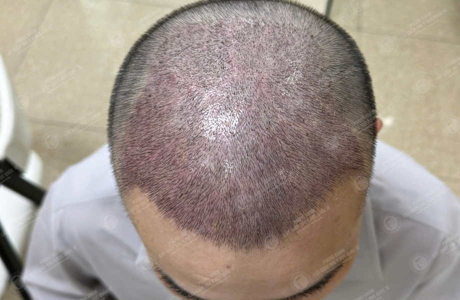 Hoàng Sơn Trung - Cấy tóc đường chữ M 7