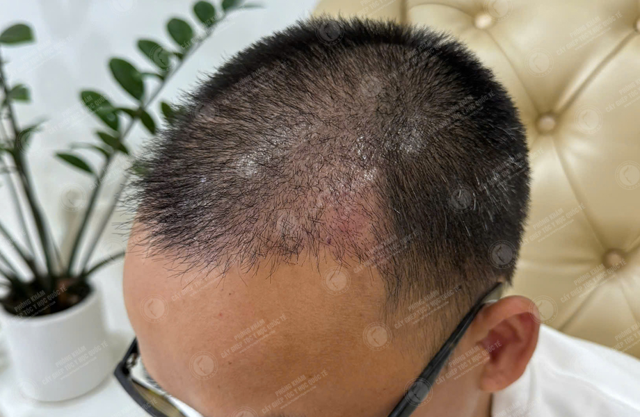 Lê Thanh Tùng - Cấy tóc đường chữ M 7