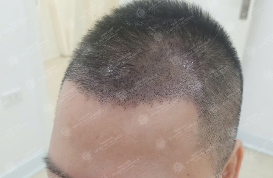 Phùng Thế Lữ - Cấy tóc đường chữ M 7
