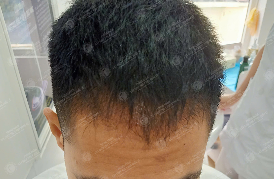 Trần Văn Nhất - Cấy tóc đường chữ M 7
