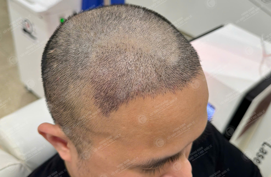 Nguyễn Tuấn Sơn - Cấy tóc đường chữ M 7