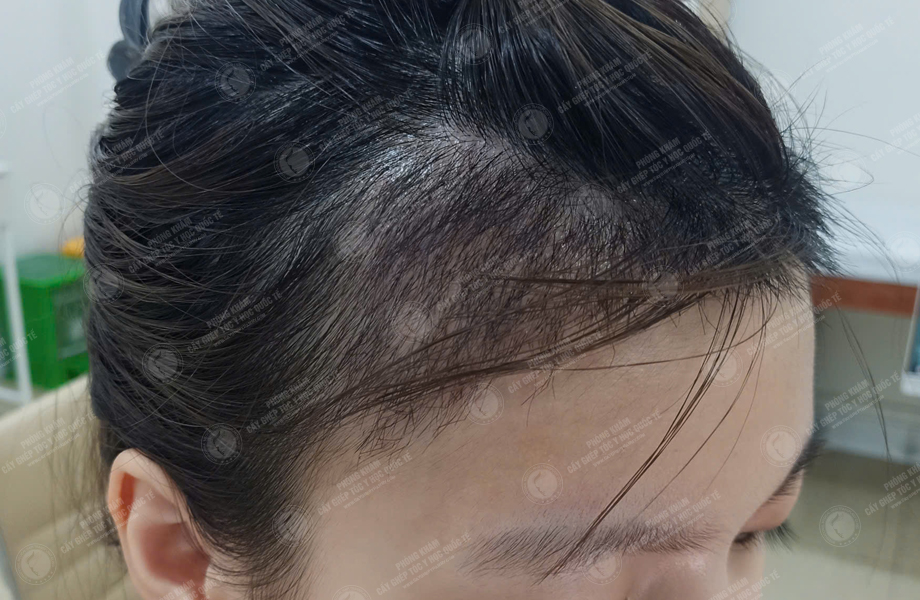 Lê Ngọc Linh - Cấy tóc đường chữ M 7