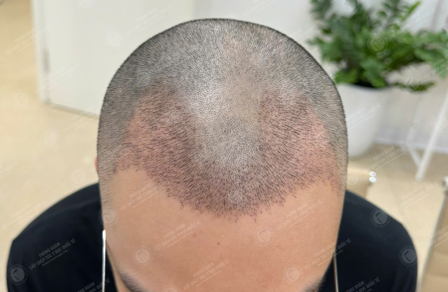 Nguyễn Thành Sơn - Cấy tóc đường chữ M 7