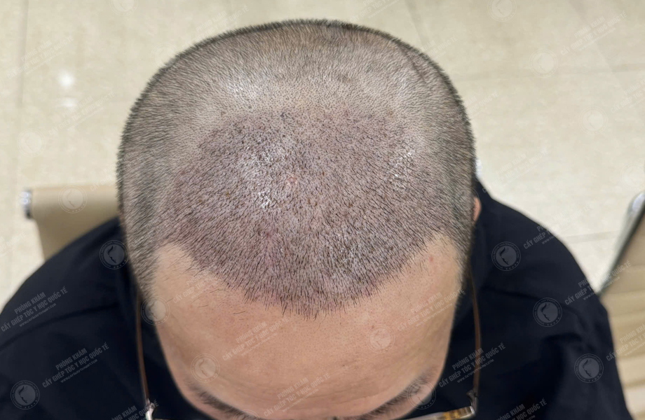 Lê Quý Sang - Cấy tóc đường chữ M 8
