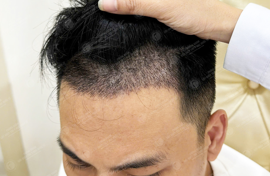 Lê Tuấn Tùng - Cấy tóc đường chữ M 7