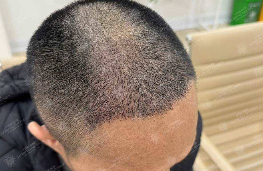 Nguyễn Đức Tâm - Cấy tóc đường chữ M 7