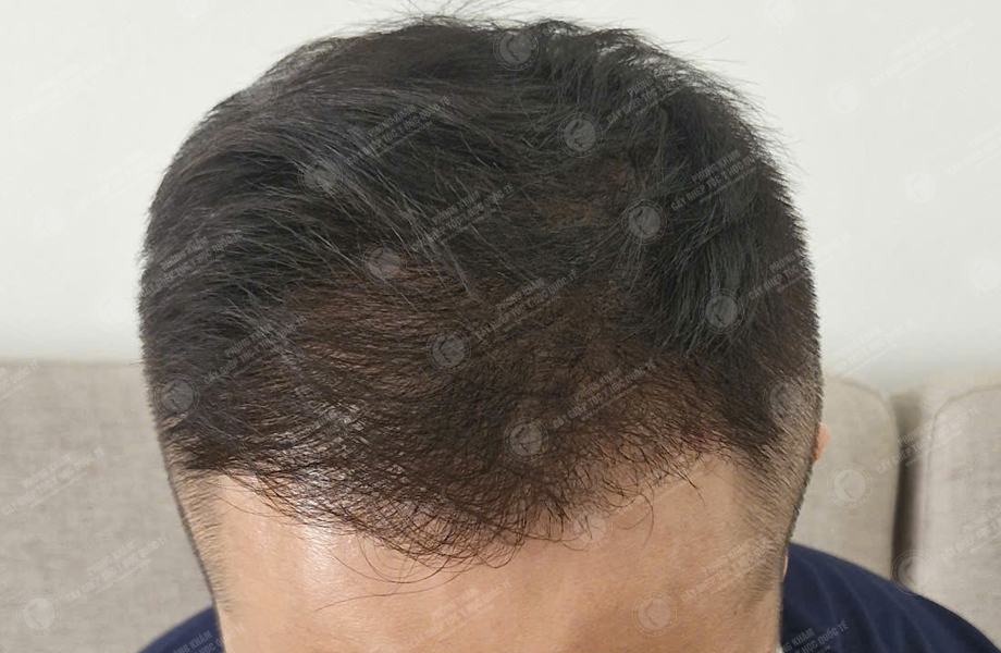 Hoàng Văn Chung - Cấy tóc đường chữ M 7