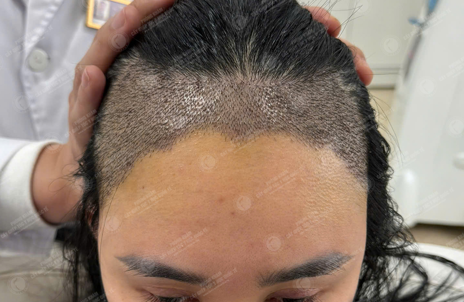 Nguyễn Tuyết Lan - Cấy tóc đường chữ M 7