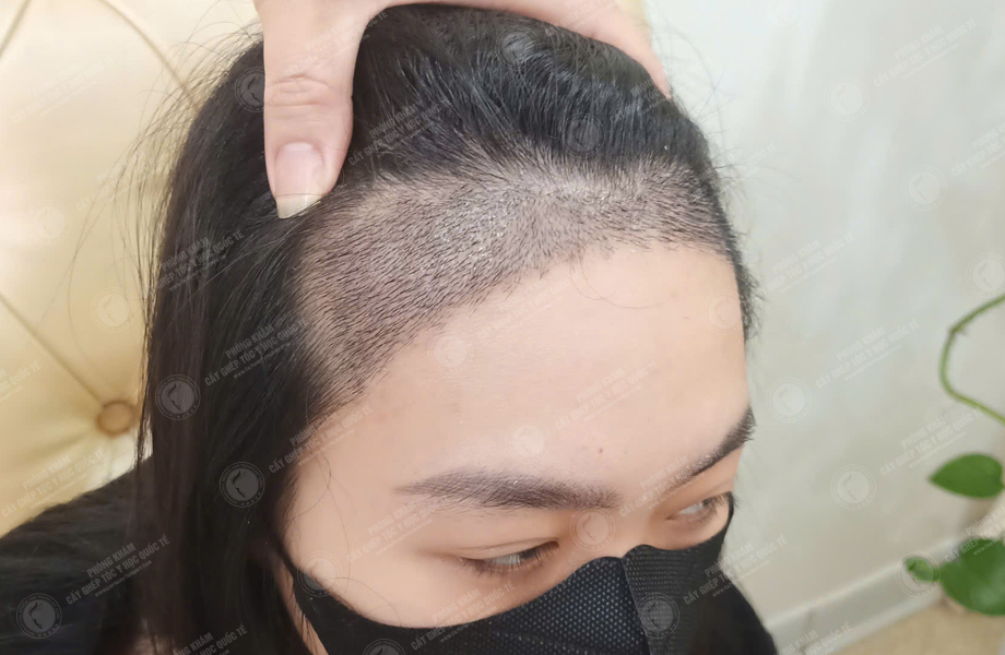 Nguyễn Hồng Hạnh - Cấy tóc đường chữ M 6