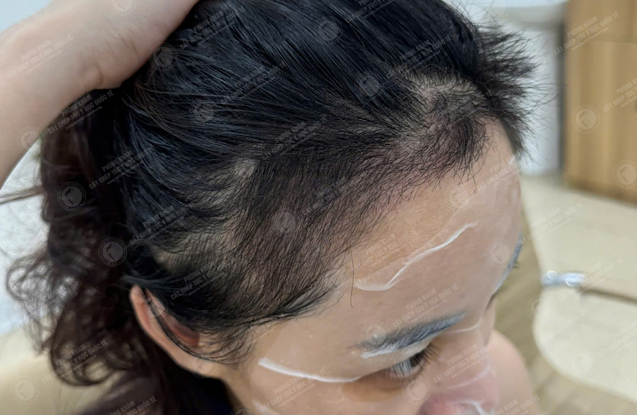 Lê Ánh Nguyệt - Cấy tóc đường chữ M 7