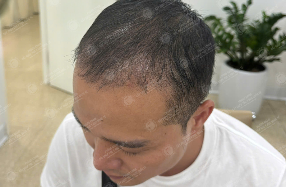 Trần Quốc Hoàn - Cấy tóc đường chữ M 7