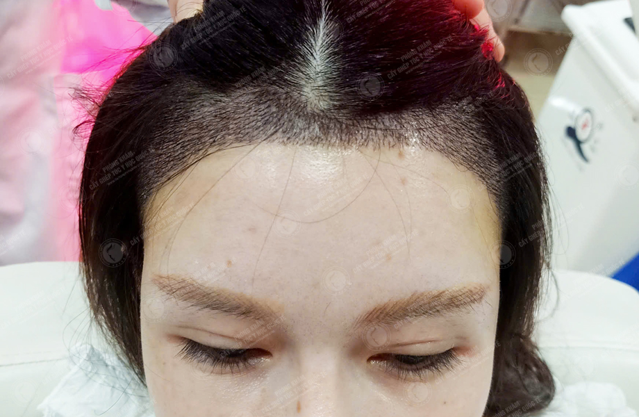 Nguyễn Mai Hoa - Cấy tóc đường chữ M 7
