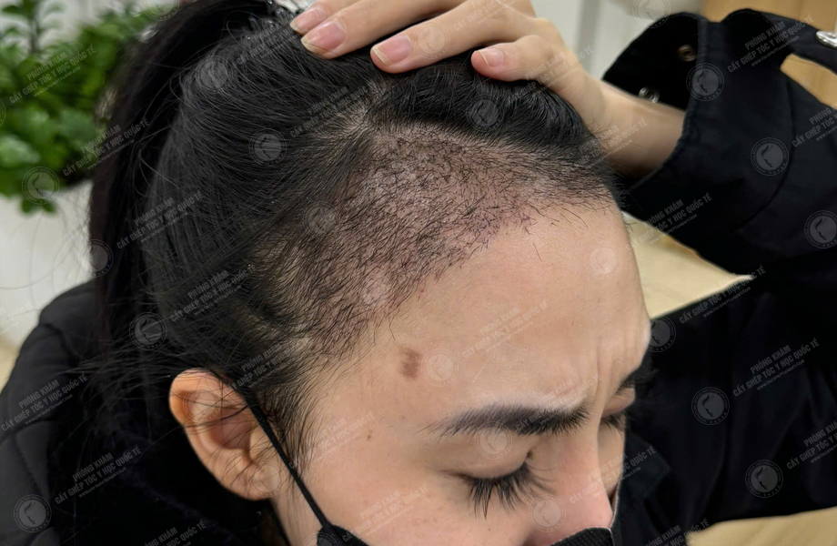 Nguyễn Tuyết Mai - Cấy tóc đường chữ M 8