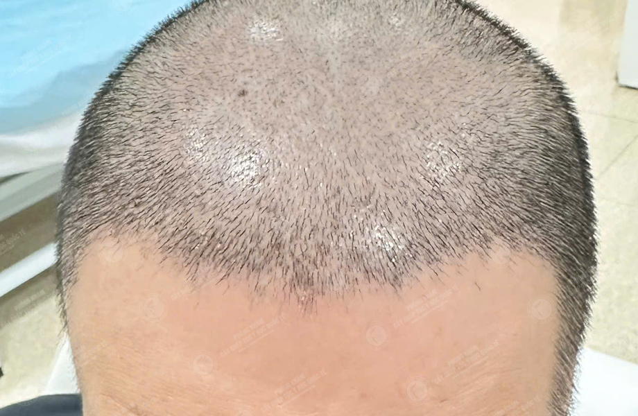 Nguyễn Hữu Cường - Cấy tóc đường chữ M 8