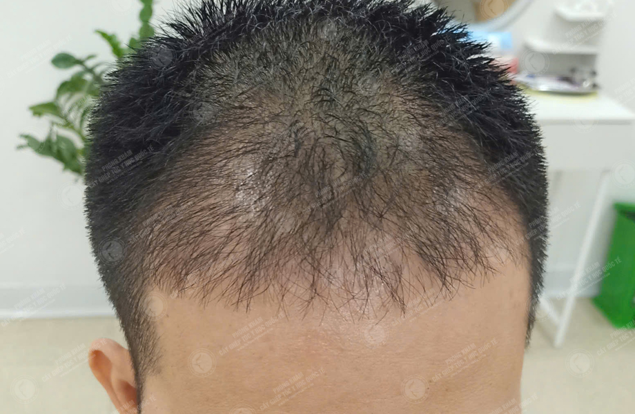 Lê Thanh Sơn - Cấy tóc đường chữ M 8