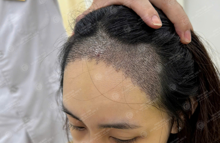 Trần Thị Hồng - Cấy tóc đường chữ M 8