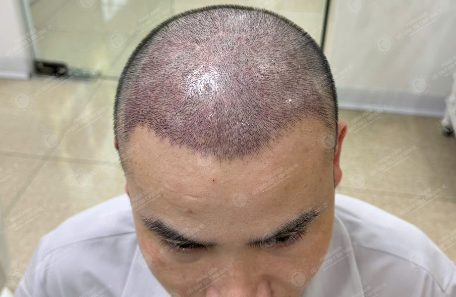 Hoàng Sơn Trung - Cấy tóc đường chữ M 8