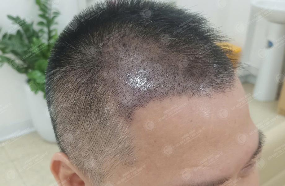 Phùng Thế Lữ - Cấy tóc đường chữ M 8