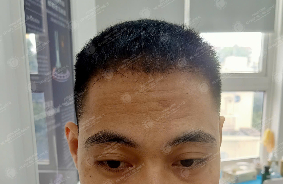 Trần Văn Nhất - Cấy tóc đường chữ M 8