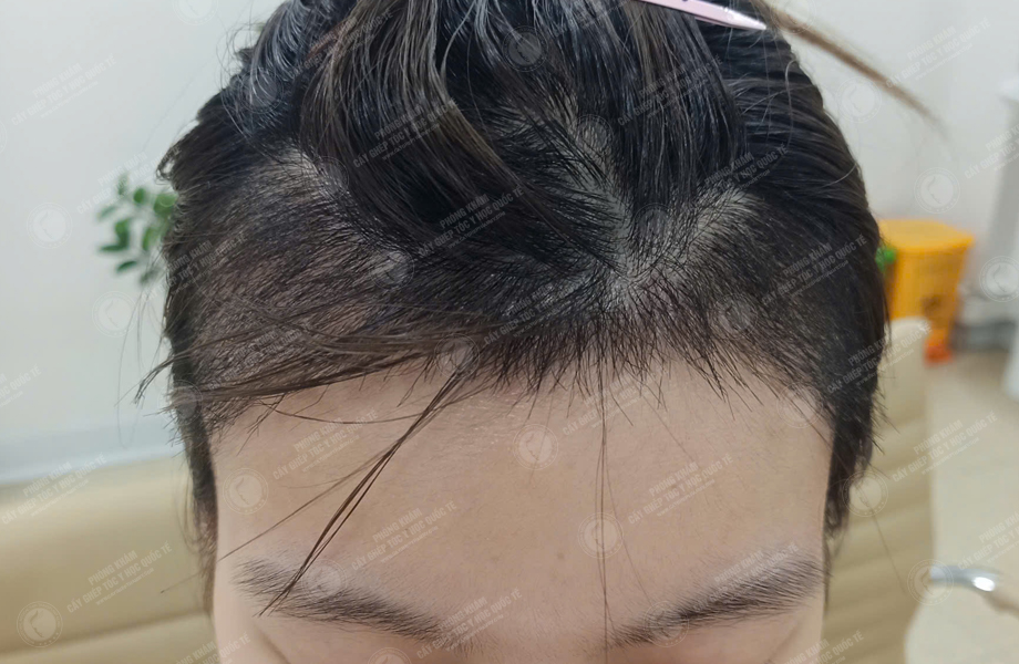 Lê Ngọc Linh - Cấy tóc đường chữ M 8