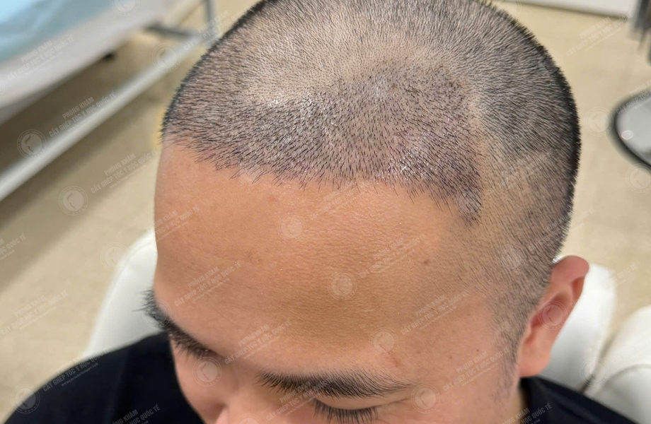 Nguyễn Tuấn Sơn - Cấy tóc đường chữ M 8