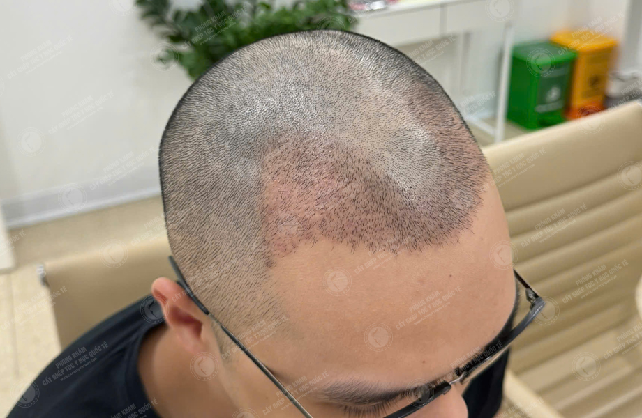 Nguyễn Thành Sơn - Cấy tóc đường chữ M 8