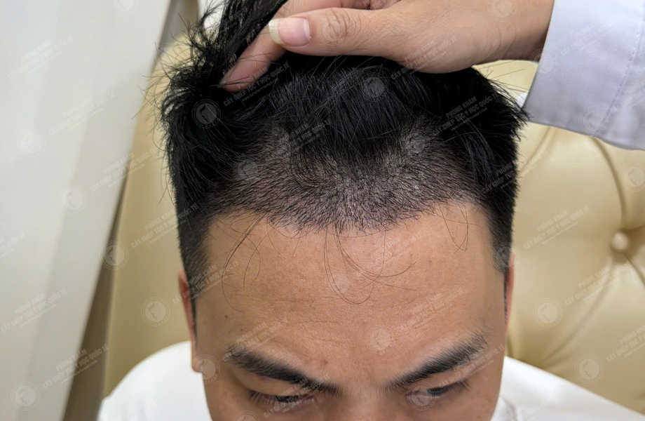 Lê Tuấn Tùng - Cấy tóc đường chữ M 8