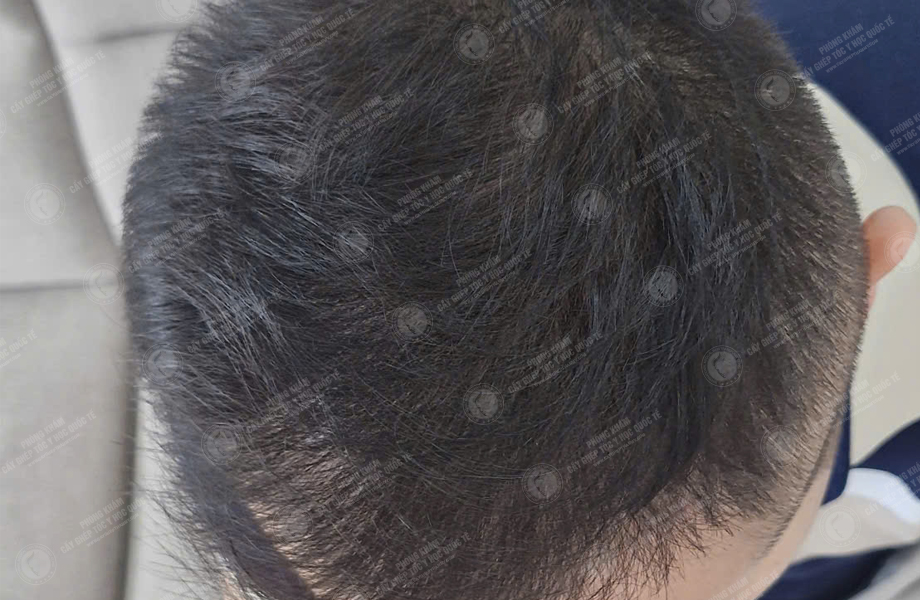 Hoàng Văn Chung - Cấy tóc đường chữ M 8