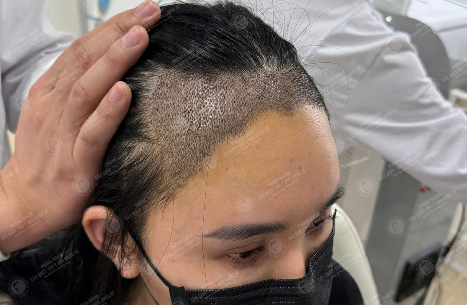 Nguyễn Tuyết Lan - Cấy tóc đường chữ M 8