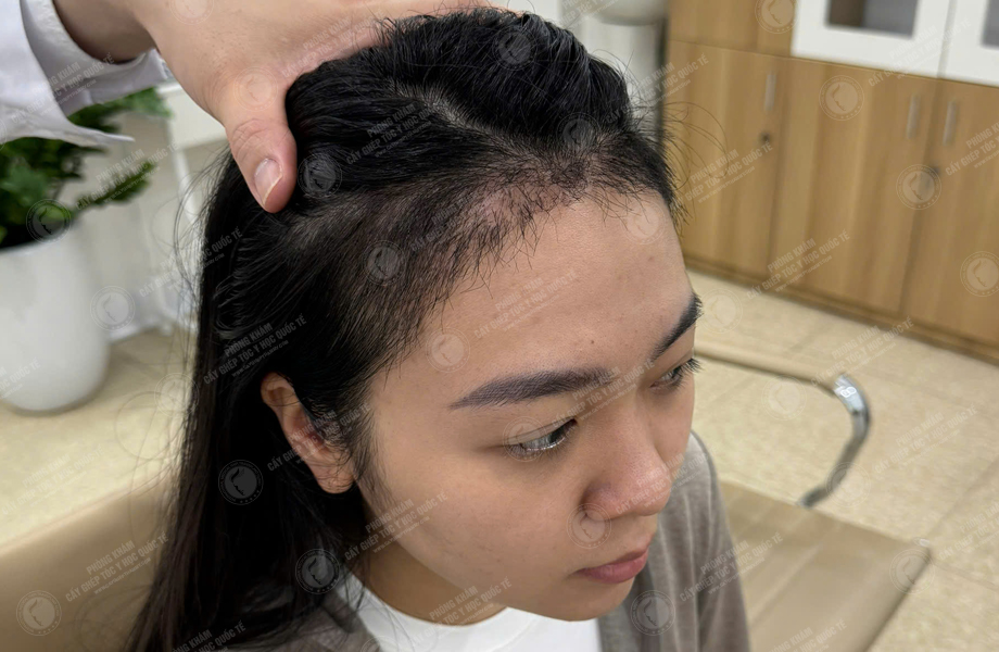 Nguyễn Hồng Hạnh - Cấy tóc đường chữ M 7