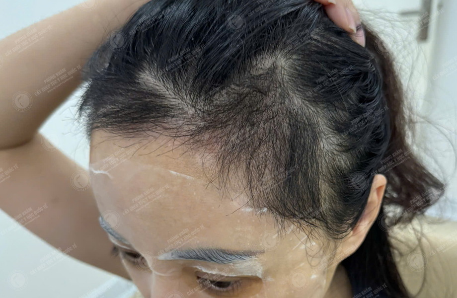 Lê Ánh Nguyệt - Cấy tóc đường chữ M 8