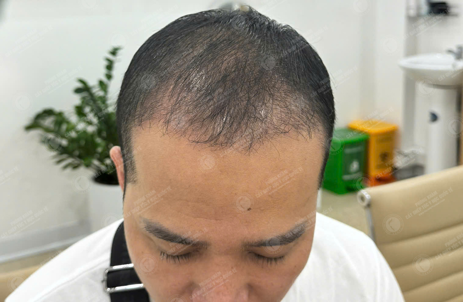 Trần Quốc Hoàn - Cấy tóc đường chữ M 8