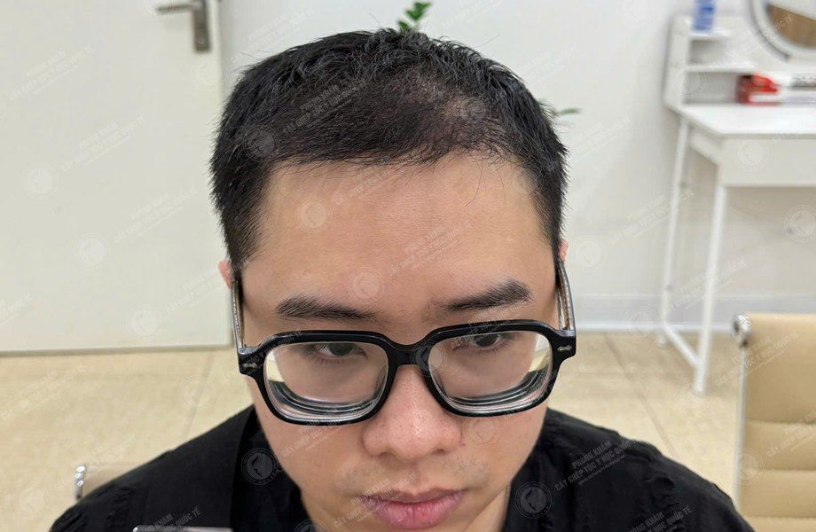 Bùi Văn Nguyên - Cấy tóc đường chữ M 8