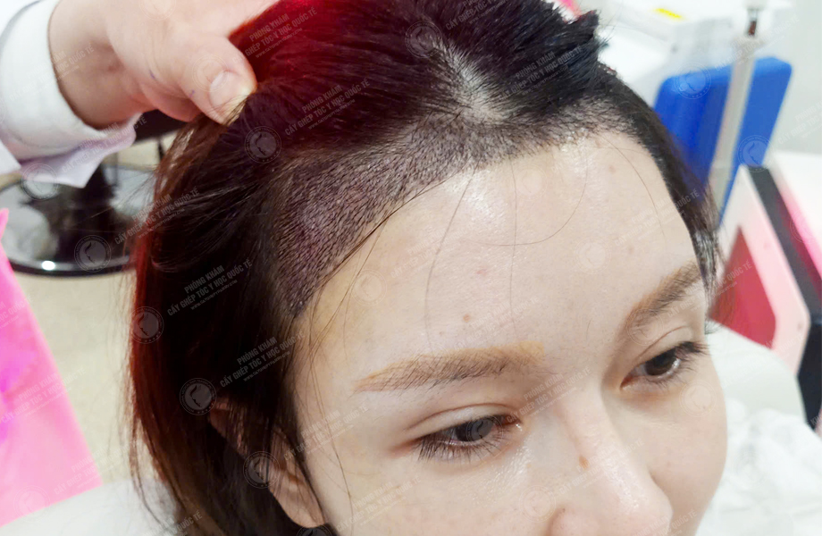 Nguyễn Mai Hoa - Cấy tóc đường chữ M 8