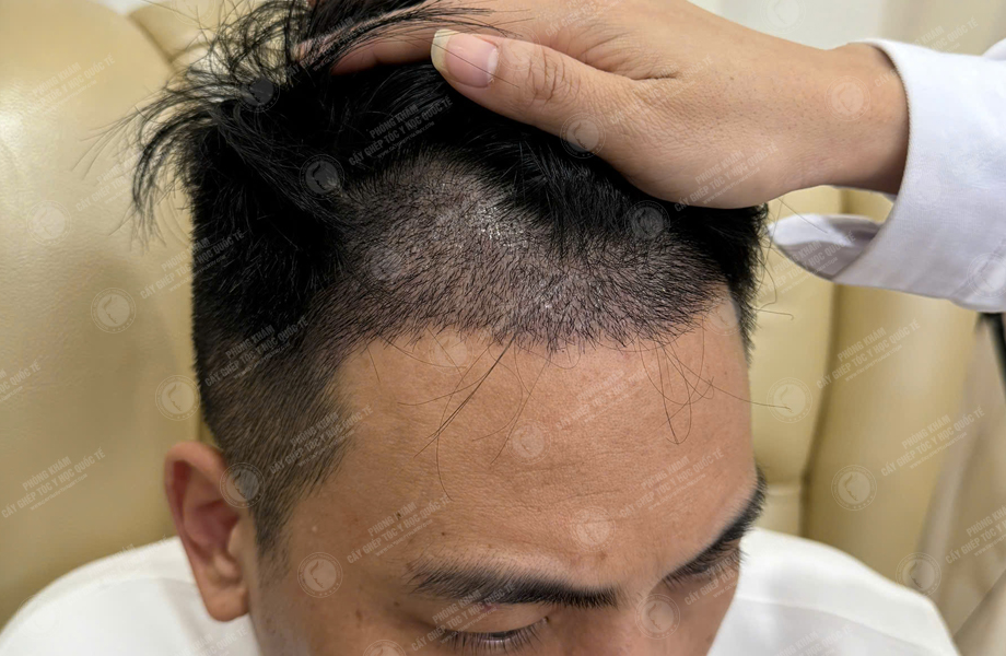 Lê Tuấn Tùng - Cấy tóc đường chữ M 9