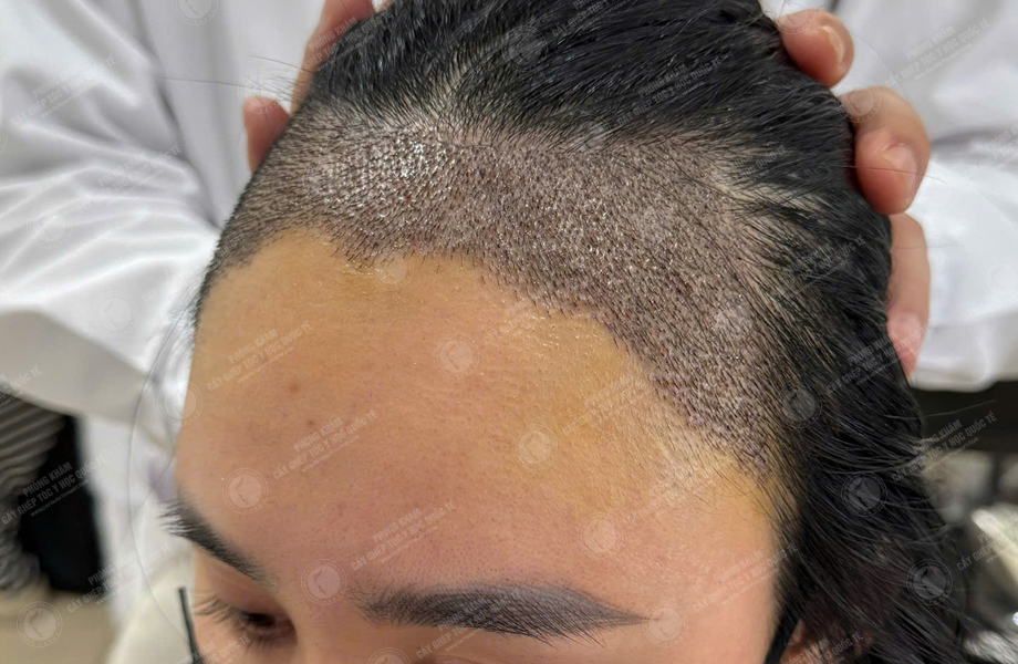 Nguyễn Tuyết Lan - Cấy tóc đường chữ M 9