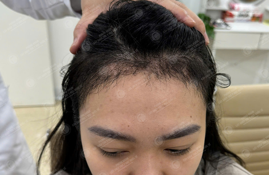 Nguyễn Hồng Hạnh - Cấy tóc đường chữ M 8